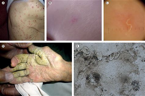 Scabies Outbreaks In Ten Care Homes For Elderly People A Prospective