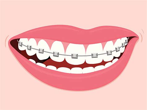 Braces Illustrations Royalty Free Vector Graphics And Clip Art Istock