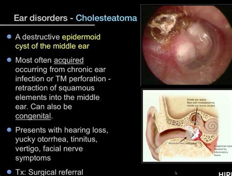 Pin By Deb Battenfield On Health Epidermoid Cyst Middle Ear Ear