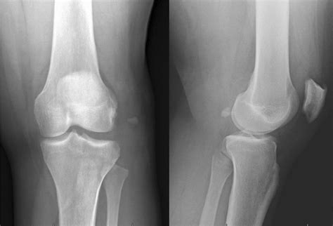 Pre Operative Anteroposterior And Lateral Radiograph Of Left Knee