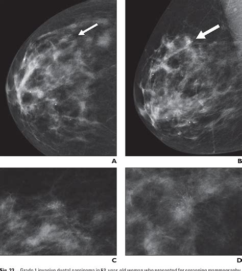 Figure 1 From Breast Calcifications The Focal Group Semantic Scholar