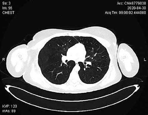 A 30 Year Old Woman With Severe Covid 19 Pneumonia After Treatment With