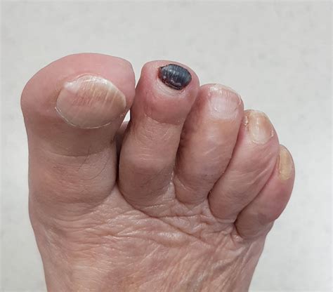 What Causes Thick Black Toenails Nail Ftempo