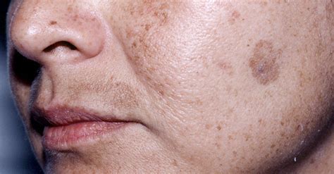 Age Spots On Face