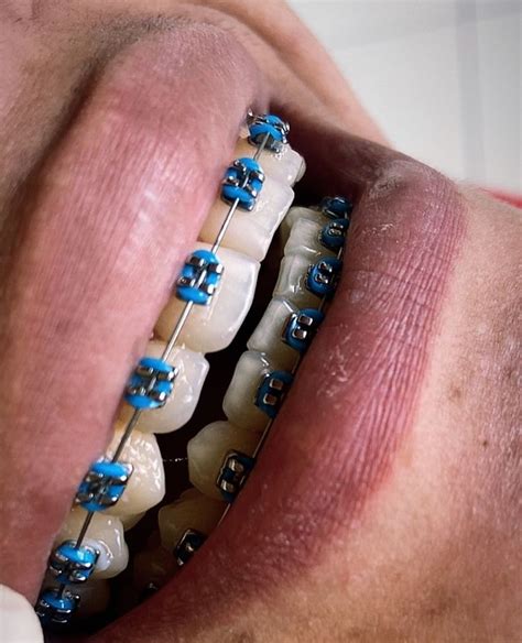 Blue Braces 💙 Dental Braces Braces Colors Braces Tips