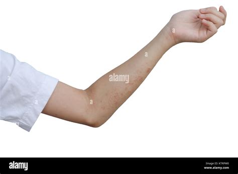 Rash And Skin On The Arms Isolated On White Background Stock Photo Alamy
