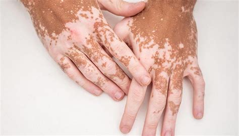 Understanding Vitiligo Causes Symptoms And Treatment Options