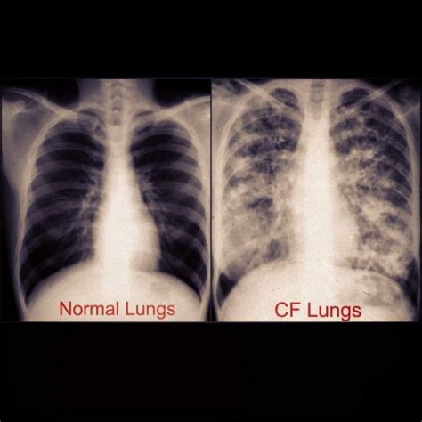 Healthy Vs Unhealthy Lung X Ray