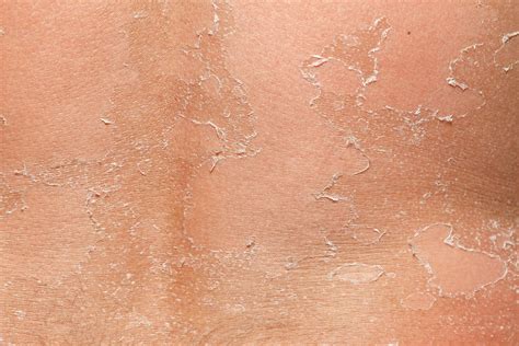 Skin Peeling: What Your Peeling Skin Wants to Tell You | The Healthy