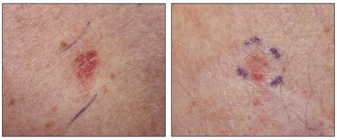 Talk with your doctor if. superficial basal cell carcinomas - pictures, photos
