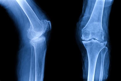 Treating Knee Osteoarthritis Without Surgery Northwestern Now
