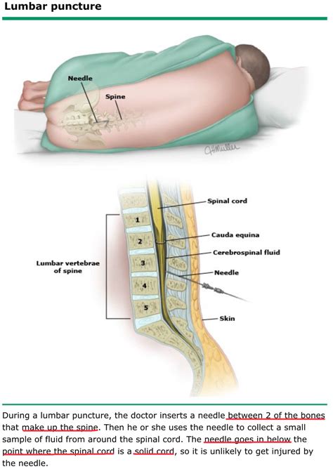 Lumbar Puncture 3 Lumbar Puncture Human Body Anatomy Medical