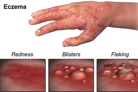 Symptoms And Identification Of 8 Different Types Of Eczema