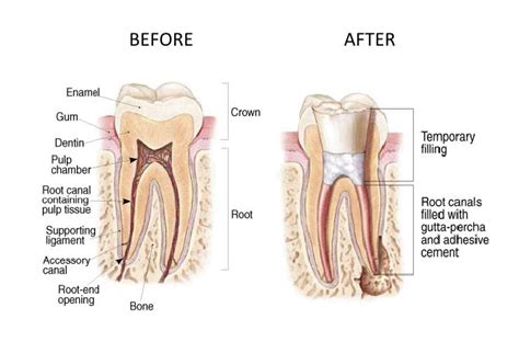 Typically, either a post remover or an ultrasonic handpiece is used to vibrate the post. Root Canal Therapy (RCT) - Monroe Family Dentistry