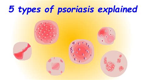 Psoriasis 5 Types Of Psoriasis Explained Youtube