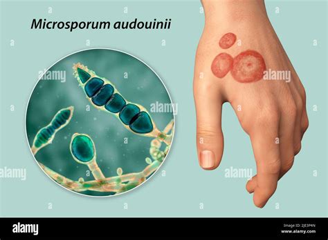 Fungal Infection On A Mans Hand Illustration Known As Ringworm