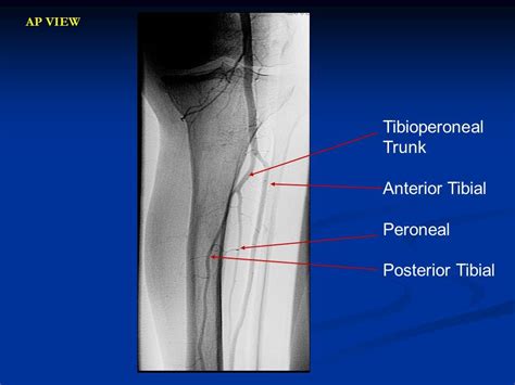 Image Result For Tibioperoneal Trunk Vascular Ultrasound Ultrasound