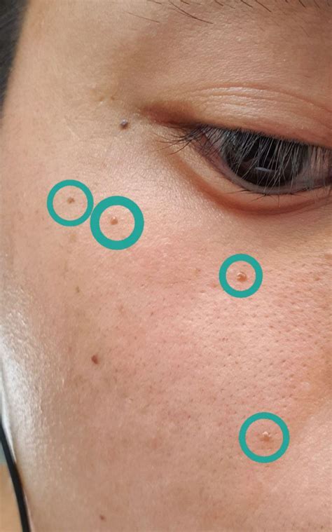 Hi Guys These Brown Bumps Circled Have Appeared On My Skin Over The