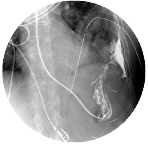Figure 1 From Gastropleural Fistula In Metastatic Ovarian Cancer