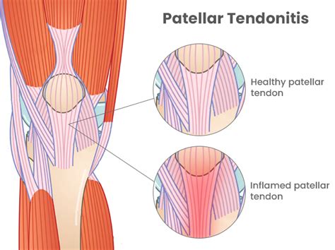 Patellar Tendonitis NYC NJ The Spine Rehab Group