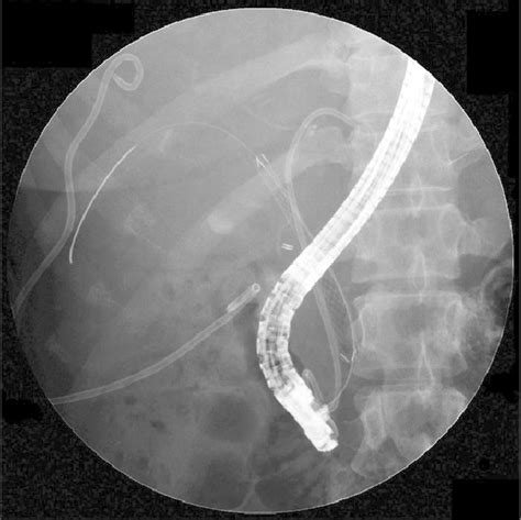 Insertion Of The Fully Covered Self Expandable Metal Stent Into The
