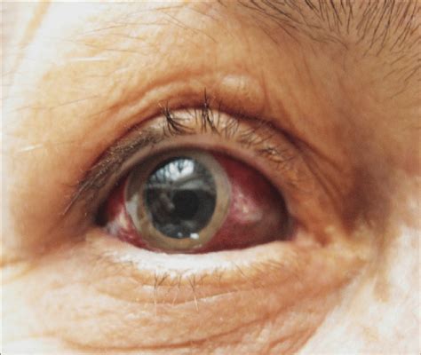 Subconjonctival Hemorrhage Edema And Spectrum Of Scleral Hematoma