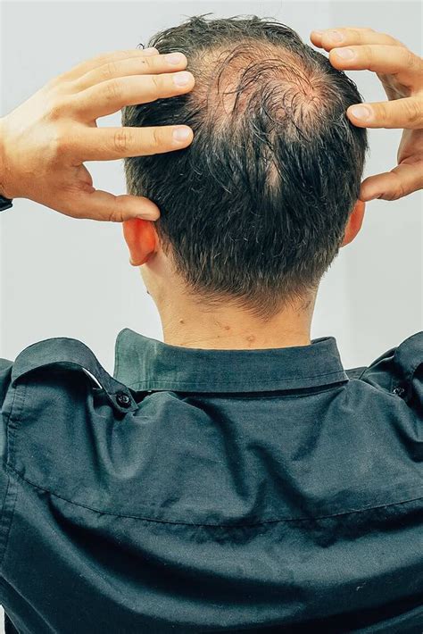 Alles Over De Verschillende Soorten Alopecia Alopecia Hair Fixing Men