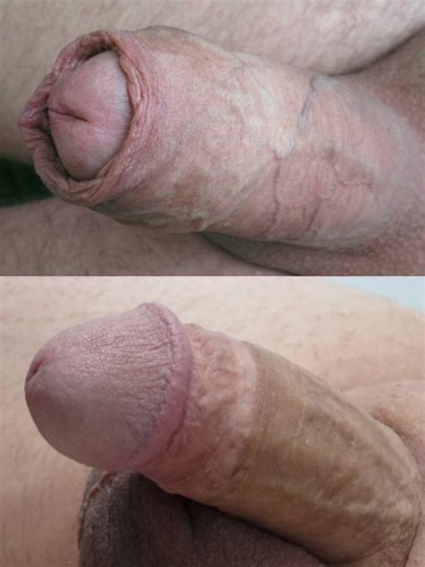 Uncircumcised Vs Circumcised Tumblr The Best Porn Website