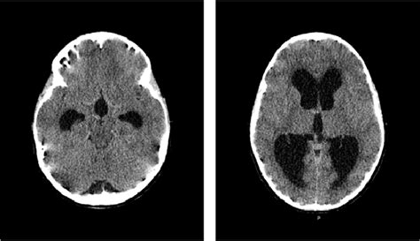 Ct Scan Of The Brain Showed Acute Hydrocephalus With Massive Dilatation