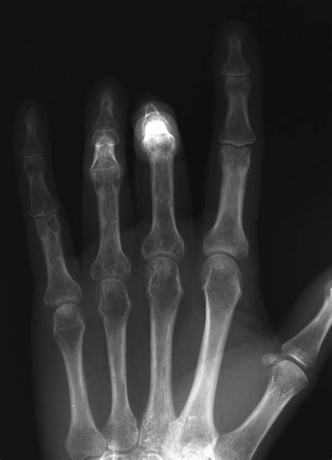 Transformation Proximal Interphalangeal Joint Flexion Contractures