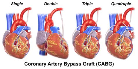 quadruple heart bypass