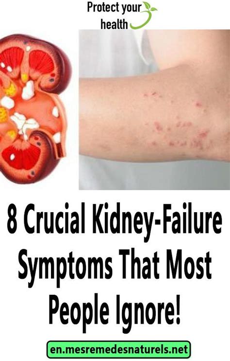 Kidney Stone Symptoms Skin Rash Kidkads
