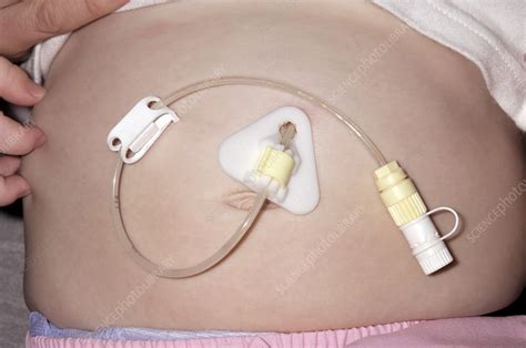 Gastrostomy Tube In A Baby Stock Image M1500310 Science Photo