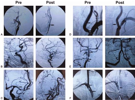 Stents Implantation In Six Typical Sites Before And After Operation