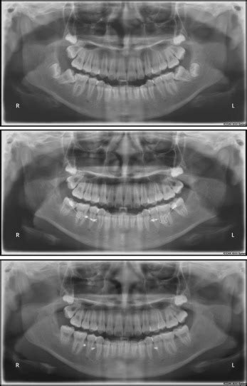 Uprighting Mesially Impacted Mandibular Molars With 2 Miniscrews
