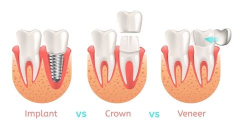 Veneers Vs Crowns Vs Implants Which Is Best