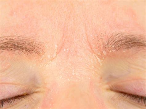 Psoriasis On The Eyelids Symptoms Causes And Treatment