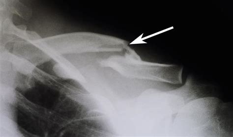 Clavical Fracture Broken Collarbone Dr Mukhis Raj Hospital