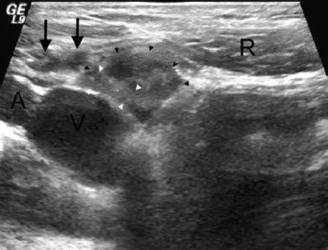 Associated with previous incision through the fascia ; Dynamic ultrasound evaluation of the inguinal hernia ...
