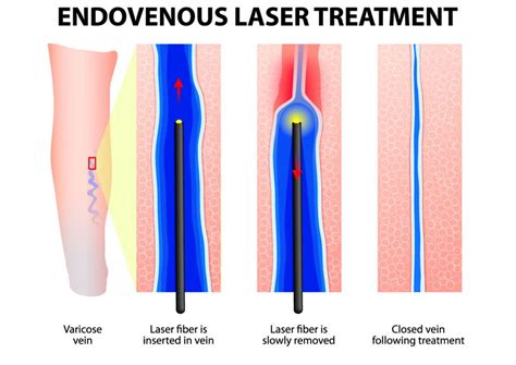 Endovenous Thermal Ablation Geelong And Surfcoast Veins