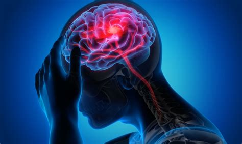 What Is A Stroke Causes Effects And Recovery Encompass Health