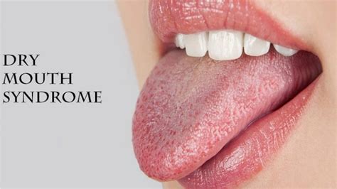 Everything You Need To Know About Dry Mouth Syndrome