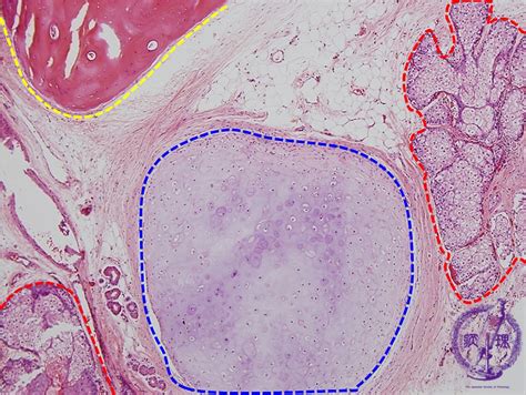 Female Genital Organs Ovarian Teratoma Mature Cystic Teratoma