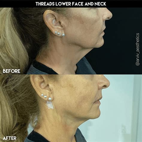 Tampa Pdo Thread Lift Non Surgical Facelift Arviv Medical Aesthetics