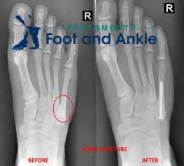 The Dreaded Jones Fracture If You Are A Sports Fan Youve Heard Of The Dreaded Jones Fracture In