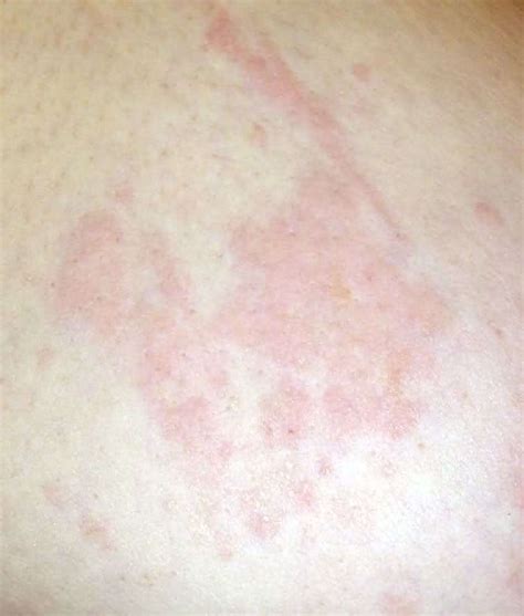 Skin Rash In Breast Cancer