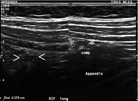 Ultrasound Of Paediatric Appendicitis And Its Secondary Sonographic
