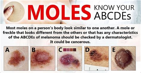 Moles Know Your Abcdes Studypk