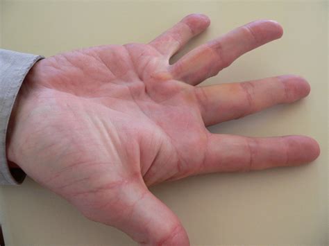 Diseases Of The Hands