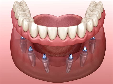 Implant Supported Dentures Integrateddental Woodbury Ny